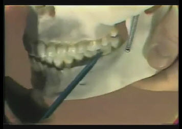 Molar 18